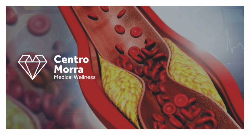 Arteriosclerosi centro morra pomigliano napoli
